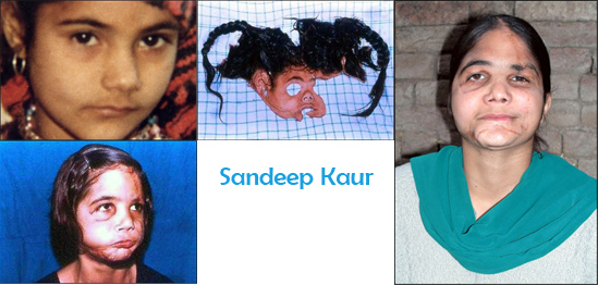 முகமாற்று அறுவைச்சிகிச்சை